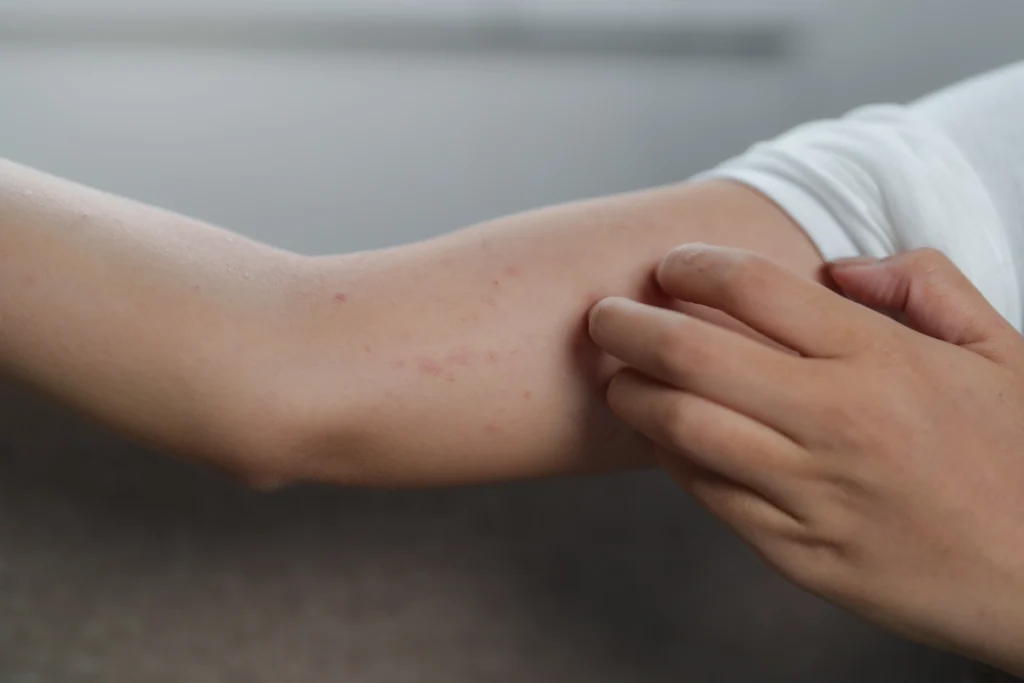 Une personne qui se gratte l'avant-bras