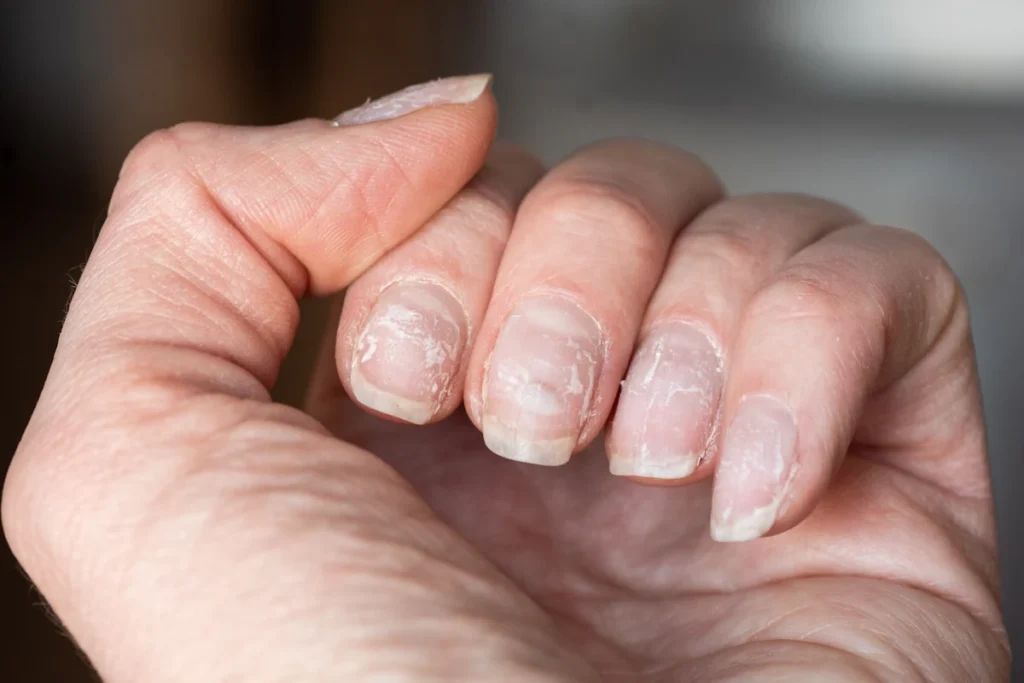 Une personne qui a les ongles cassants à cause d'un manque de calcium