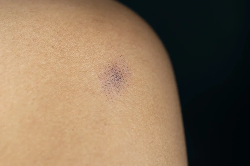 Un bleu sur une peau