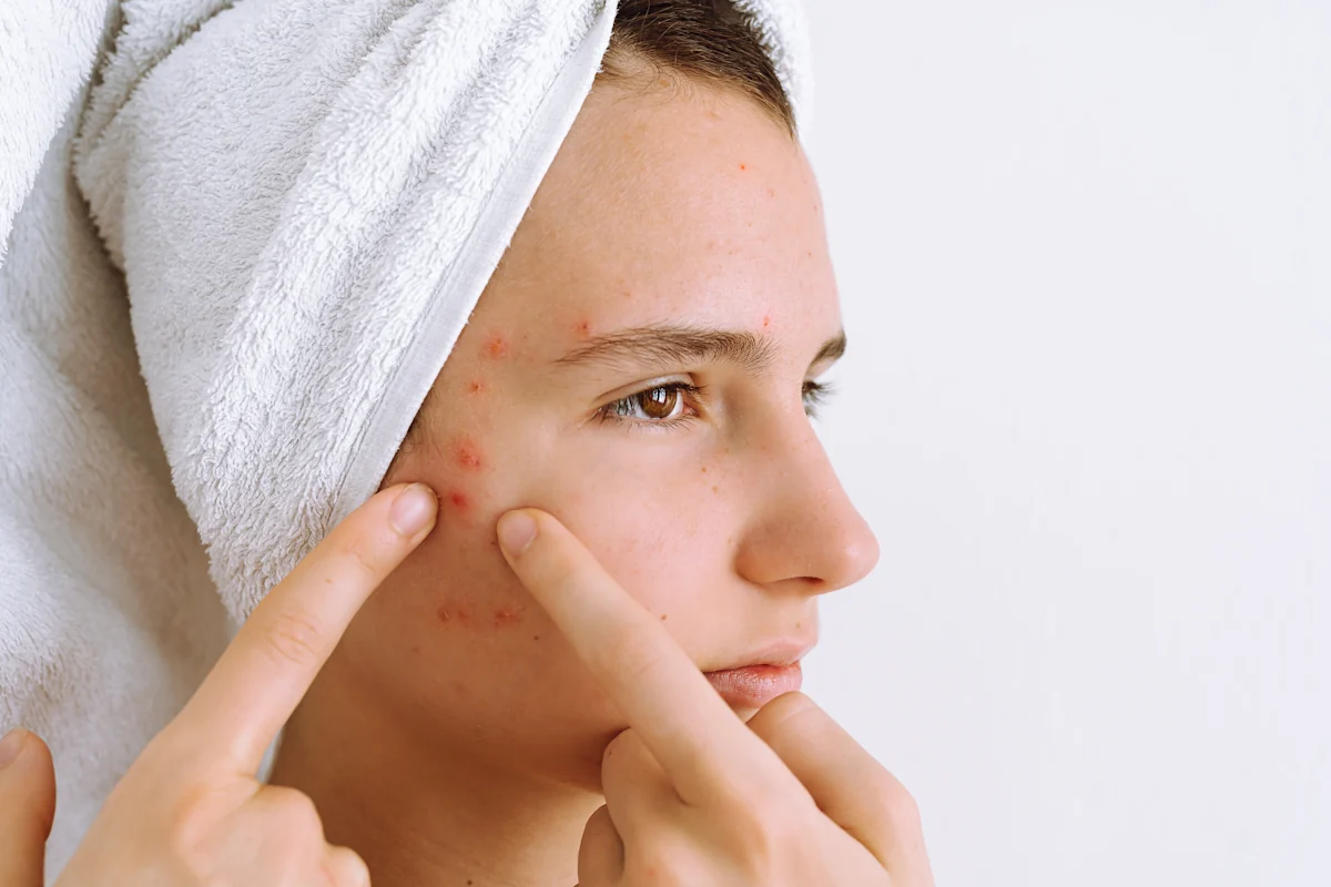 Une personne avec une peau acnéique par manque de zinc